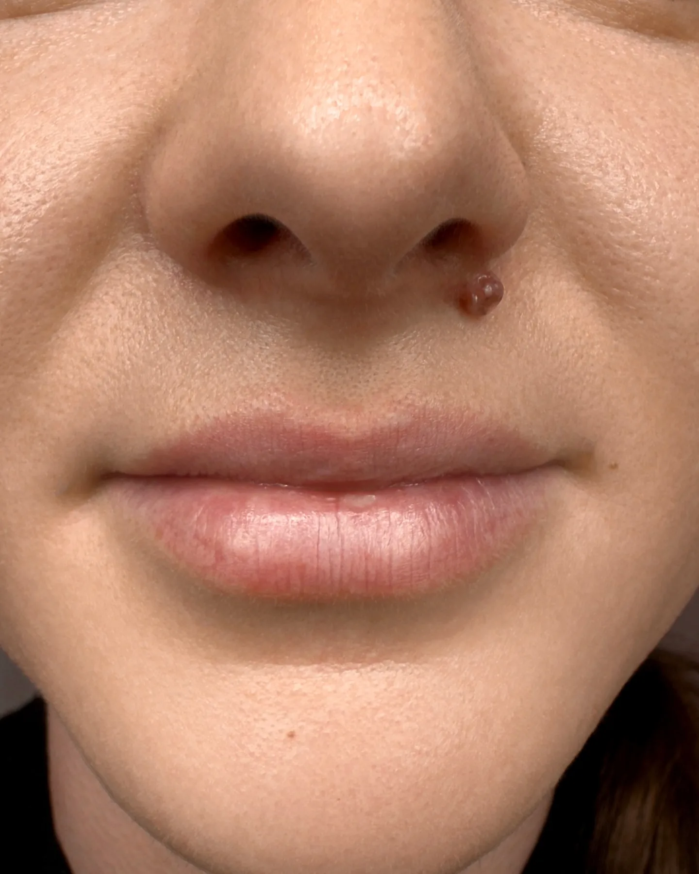 Lippen · Ergebnis nach der Heilung